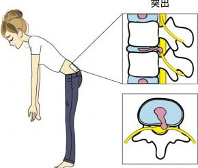 突出型ヘルニアのイラスト|奈良の整体,カイロ院の山縣カイロプラクティック院