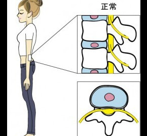 正常な腰椎椎間板のイラスト|奈良の整体,カイロ院の山縣カイロプラクティック院
