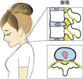 膨隆型ヘルニアのイラスト|奈良の整体,カイロ院の山縣カイロプラクティック院