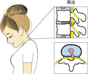 突出型ヘルニアのイラスト|奈良の整体,カイロ院の山縣カイロプラクティック院